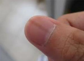 指甲特大有纵纹而手指细